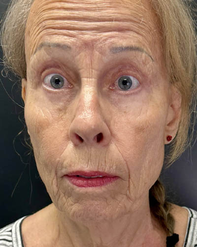 Blepharoplasty case #4804