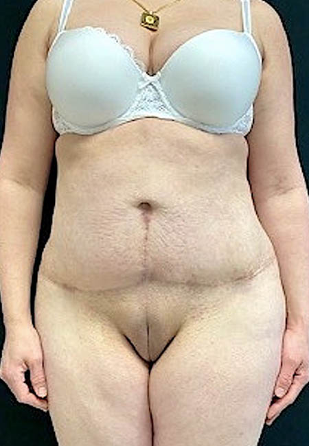 Tummy Tuck case #4695