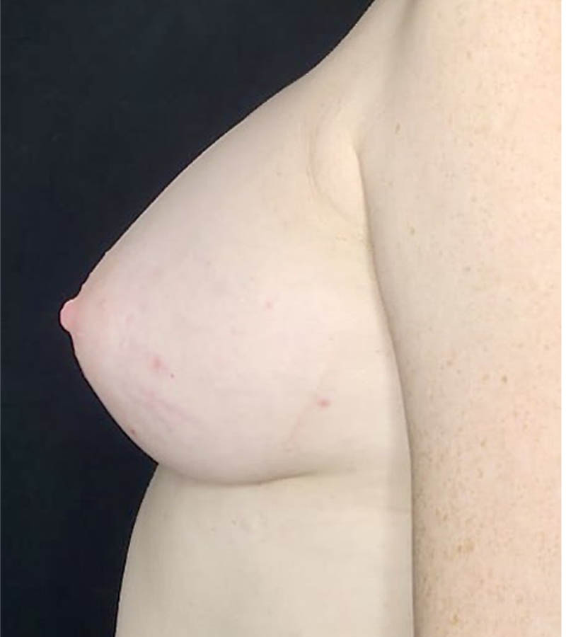 Breast Augmentation case #4759