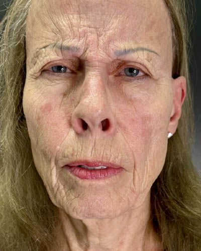 Blepharoplasty case #4804