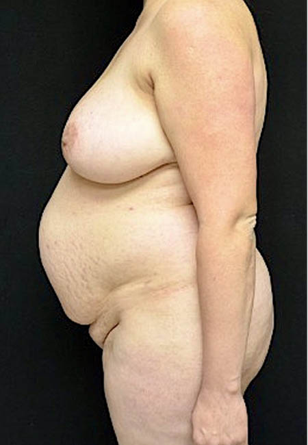 Tummy Tuck case #4695