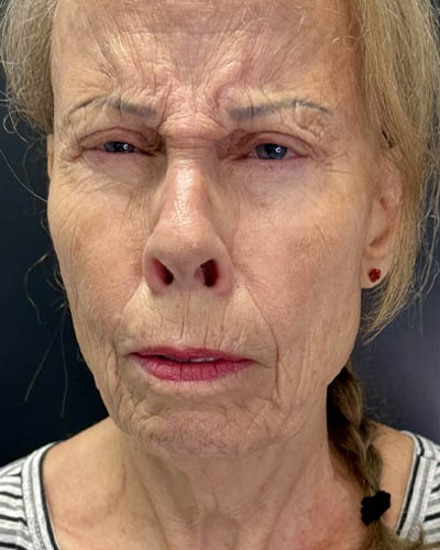 Blepharoplasty case #4804