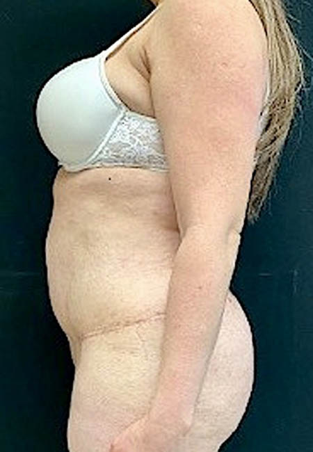 Tummy Tuck case #4695