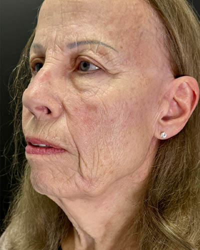 Blepharoplasty case #4804