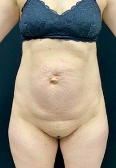 Tummy Tuck case #4707