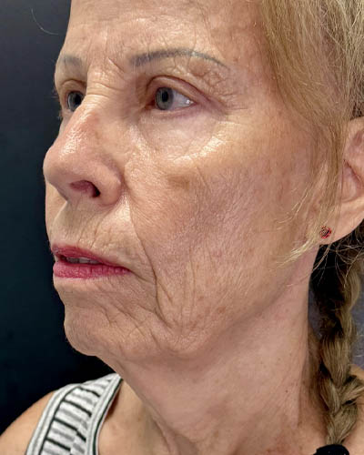 Blepharoplasty case #4804
