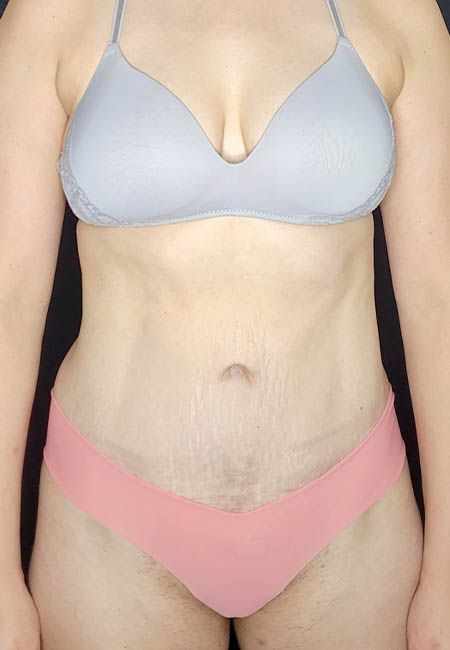 Tummy Tuck case #4707
