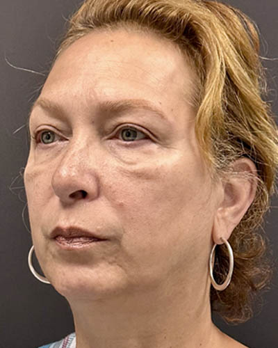 Blepharoplasty case #4821