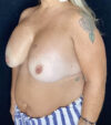 Breast Revision case #4781
