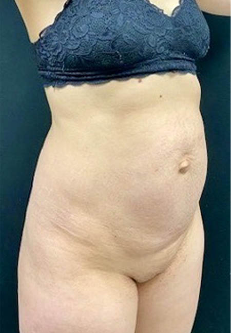 Tummy Tuck case #4707