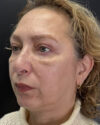 Blepharoplasty case #4821