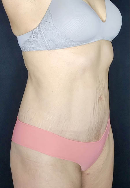 Tummy Tuck case #4707