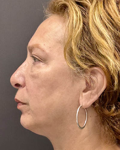 Blepharoplasty case #4821