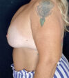Breast Revision case #4781