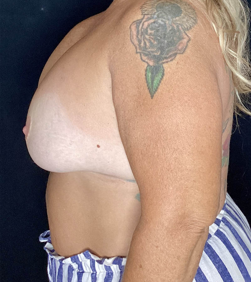 Breast Revision case #4781