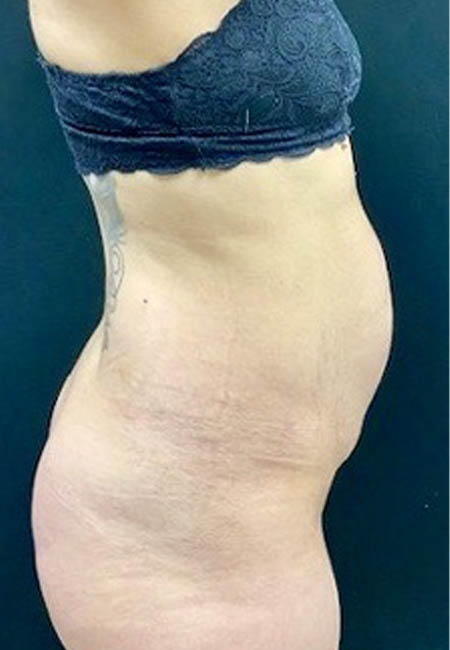 Tummy Tuck case #4707
