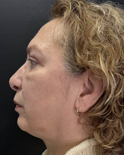 Blepharoplasty case #4821