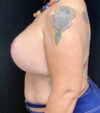 Breast Revision case #4781