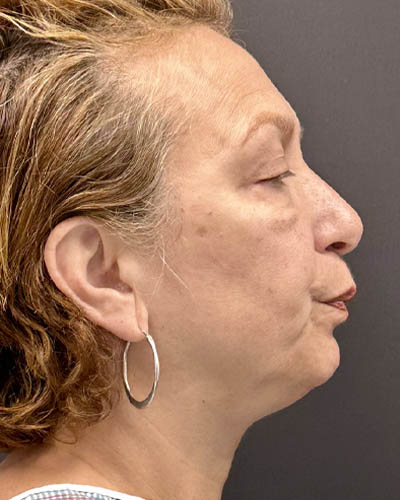 Blepharoplasty case #4821