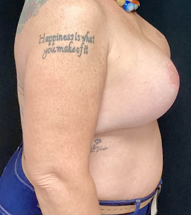 Breast Revision case #4781