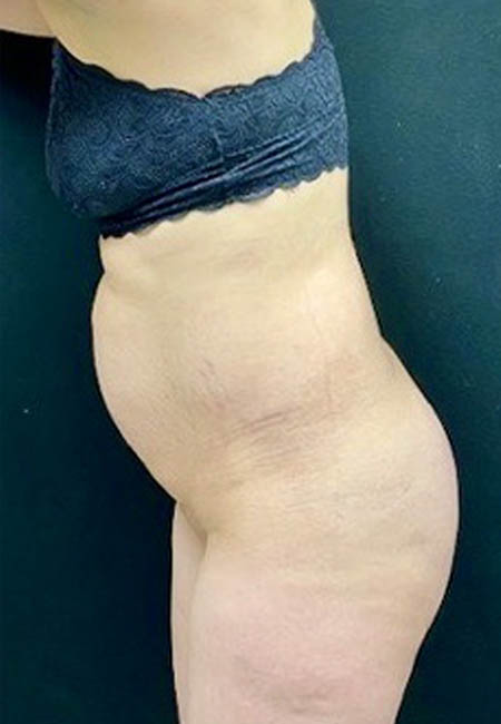 Tummy Tuck case #4707