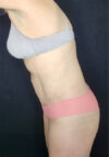 Tummy Tuck case #4707