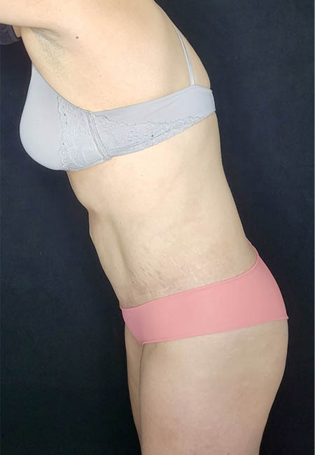 Tummy Tuck case #4707