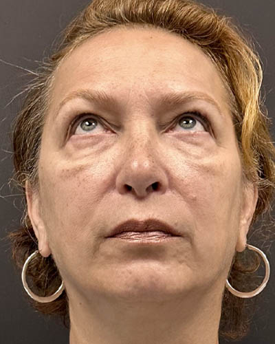Blepharoplasty case #4821