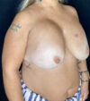Breast Revision case #4781
