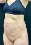 Tummy Tuck case #4707