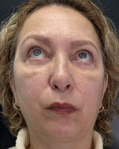Blepharoplasty case #4821