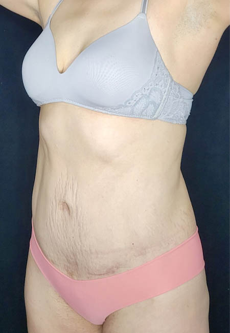 Tummy Tuck case #4707