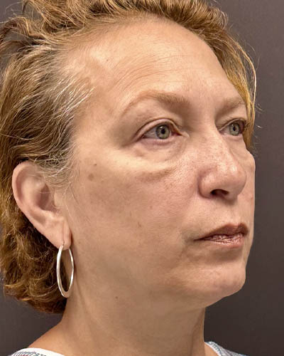 Blepharoplasty case #4821