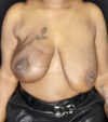 Breast Revision case #4792
