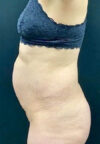 Tummy Tuck case #4707