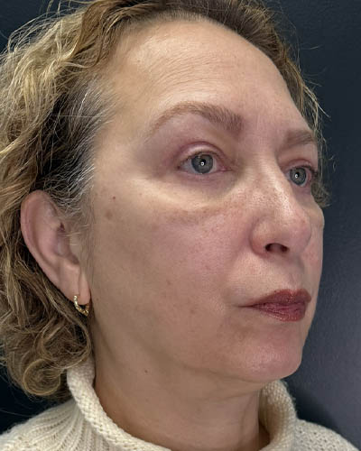 Blepharoplasty case #4821