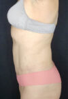 Tummy Tuck case #4707