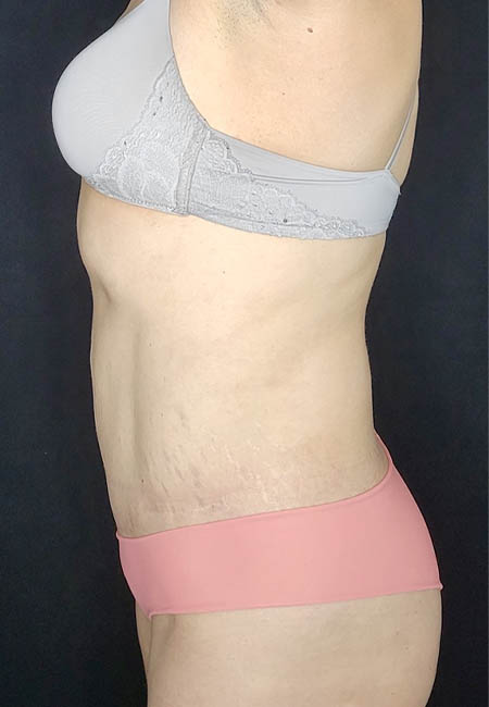 Tummy Tuck case #4707
