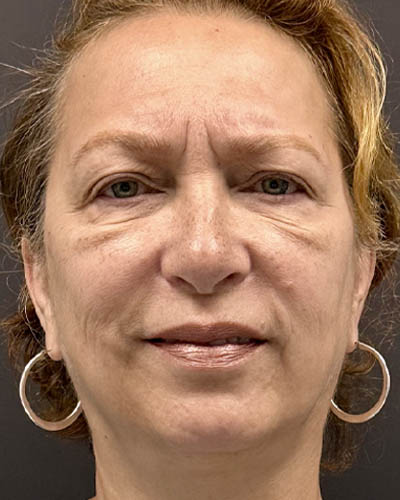 Blepharoplasty case #4821