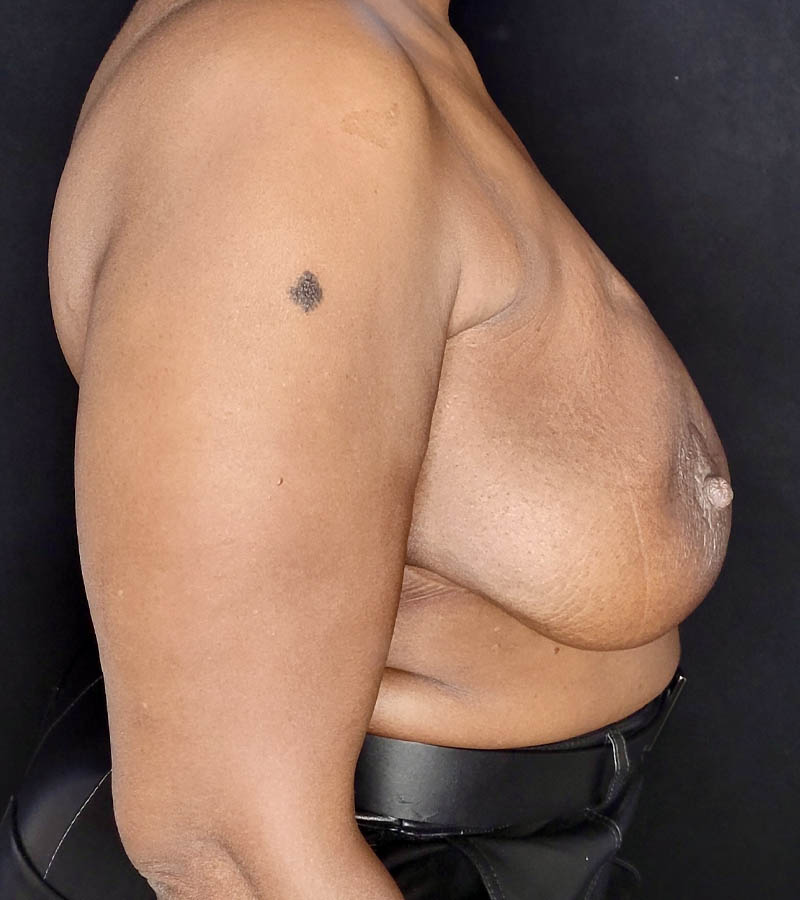 Breast Revision case #4792