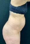 Tummy Tuck case #4707