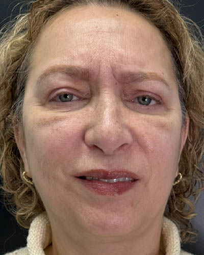 Blepharoplasty case #4821