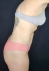 Tummy Tuck case #4707