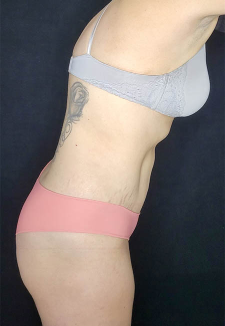 Tummy Tuck case #4707