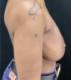 Breast Revision case #4792