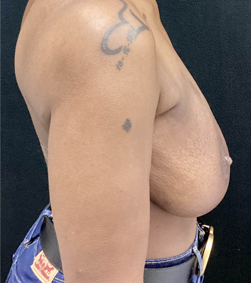 Breast Revision case #4792