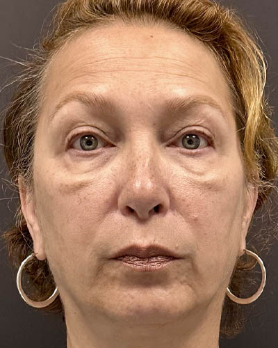 Blepharoplasty case #4821