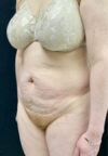 Tummy Tuck case #4722