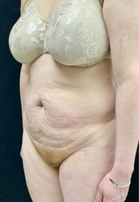 Tummy Tuck case #4722