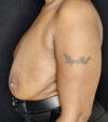 Breast Revision case #4792